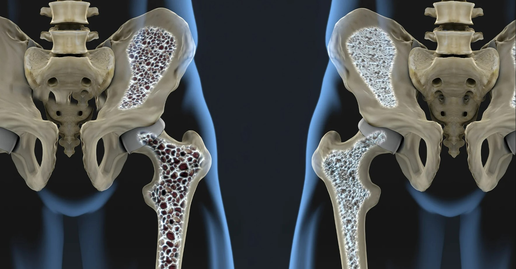 healing osteoporosis with promedical PEMF therapy